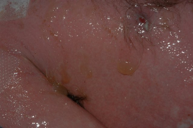 24 Year old male in early stage of Toxic Epidermal Necrolysis Syndrome with severe Ocular involvement. Approximately 4 days into reaction. (8)
